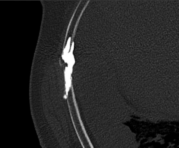 Cementoplasty of the rib, again giving excellent pain relief.
All images...