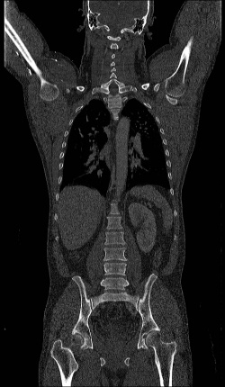 Photo: Polytrauma-Ganzkörper-CT im Schockraum