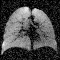 Lunge eines gesunden Patienten