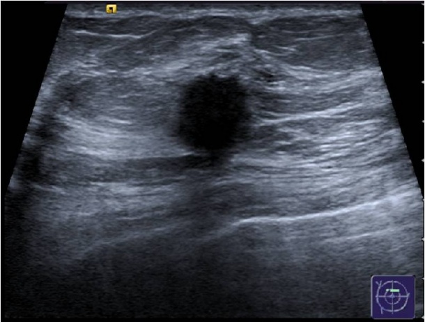 B: Ultrasound:hypoechoic lesion, round, spiculated, size 12 mm, US BI-RADS 5