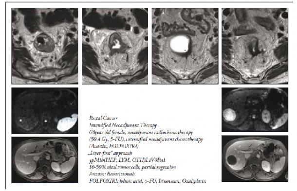 Rectal Cancer; Intensified Neoadjuvant Therapy; 68year old female, neoadjuvant...