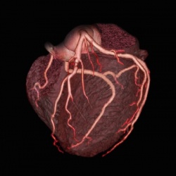 Herz CT