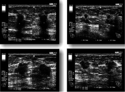 Ultrasound of breast cancer