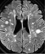 Photo: Multiple sclerosis