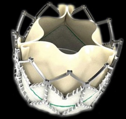 Edwards Sapien XT Transcatheter Heart Valve