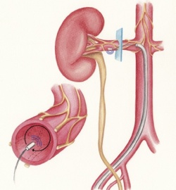 Renal denervation