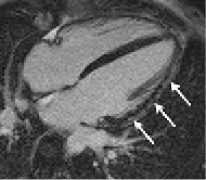 CMR image of a patient with myocarditis; the lighter coloured lateral wall...