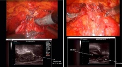 Left: The endorectal ultrasound transducer is registered to the robot and...
