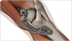 Photo: Entlastungsfedern in den Knien hilft Arthrose Patientin