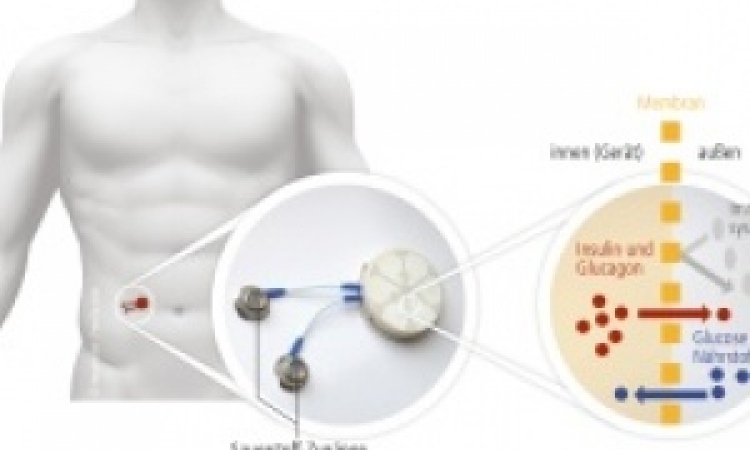 Dresdner Forschern gelingt mit knstlichem Pankreas Durchbruch in der  Diabetestherapie  healthcare-in-europe.com