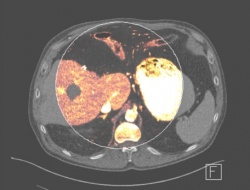 The iodine related attenuation image created from the dual energy CT data...