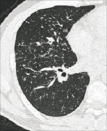 Typischer Befund eines pulmonalen Befalls bei einer Sarkoidose 