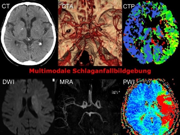 Multimodale CT- und MRT-Bildgebung bei Schlaganfall