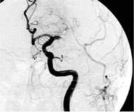 Occlusion of the main stem of the left middle cerebral artery, which was...