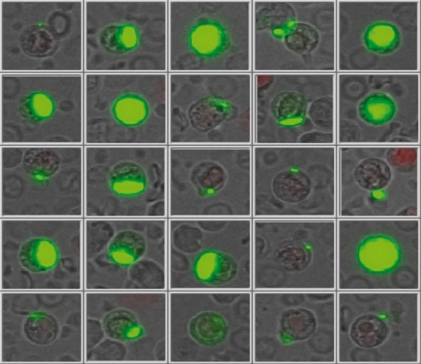 Erscheinungsbild lebender Tumorzellen unter Elektronenmikroskop
(Bildquelle:...