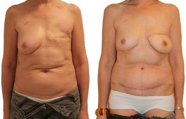 DIEP flap breast reconstruction