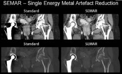 Neue Single-Energy-Metall-Artefact-Reduction (SEMAR) für die deutlich...