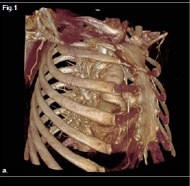 Virtual anatomy and virtual dissection of the heart and the thoracic vessels....
