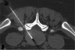 Angiography: ozone injection in the intervertebral disc
Picture: Hospital St....