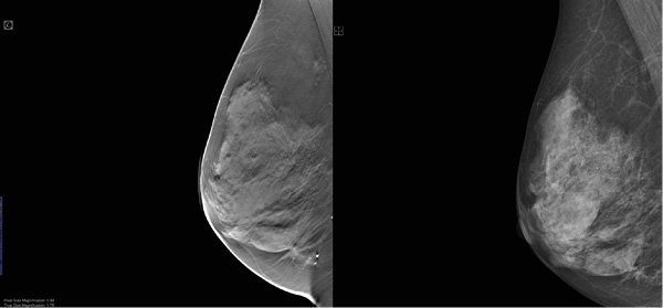 The image shows the visibility of a spiculated mass with 3-D tomosynthesis...