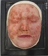Moulage, Syphilis II (Gesicht) [Kaltschmidt], 27,5x23,5...