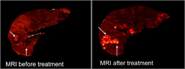 Accumulation of holmium in the liver before andafter treatment
Source: UMC...