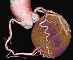 Dreidimensionale Bildfusion aus SPECTPerfusion und CT-Koronaranatomie.