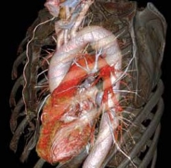 Triple-Rule-Out: Revolution CT scant Aorta, Herz und Lunge in nur einem Scan,...