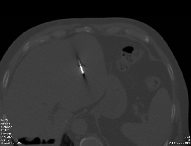 CT-gezielte Mikrowellenablation eines Lebertumors