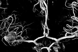 Ein Aneurysma der rechten Arteria cerebri media in einer hochaufgelösten...