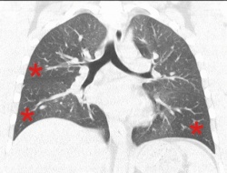 Coronale CT eines 16-jährigen Patienten mit einem Asthma-Anfall. Als...