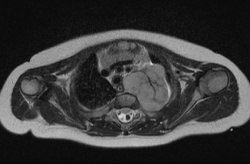 T2-gewichtetes atemgetriggertes Bild eines thorakalen Neuroblastoms eines 8...