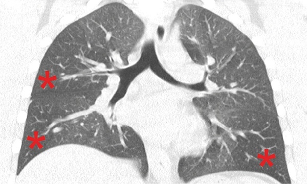 Coronary CT of a 16-year-old patient suffering an asthma attack. Most...