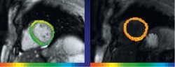 Pre- (left) and post-contrast image set showing, by parametric imaging the drop...