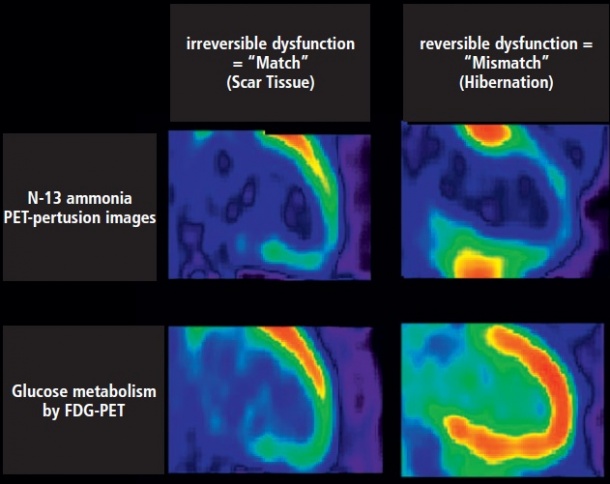 PET assessment of myocardial viability or hibernation