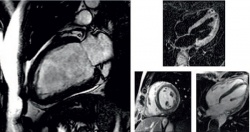 Example: Myocarditis – 23-year-old male with no abnormalities is seen in...