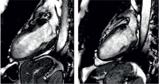 Example: Takotsubo Cardiomyopathy – 45-year-old female, with no...