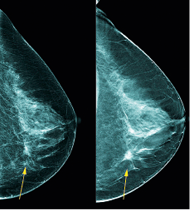 Mortality rates from breast cancer can be reduced by screening