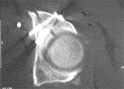 Acetabular posterior fracture - CT slice