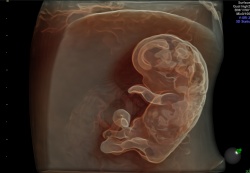 Photo: The world’s first 4D Curved Matrix Array probe for prenatal screening
