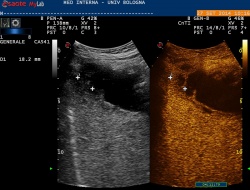 Acute cholecistitis