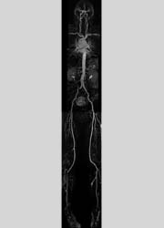 Whole body MR angiography in a 72-year-old male with bilateral leg claudication...