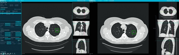 Automatic side by side comparison with prior cases and findings