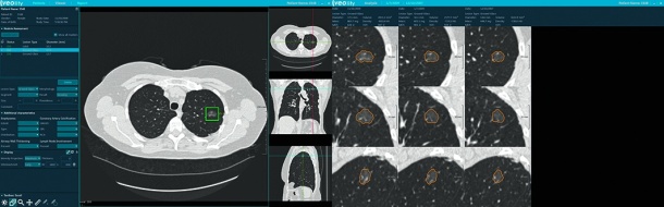 Volumetric nodule growth assessment