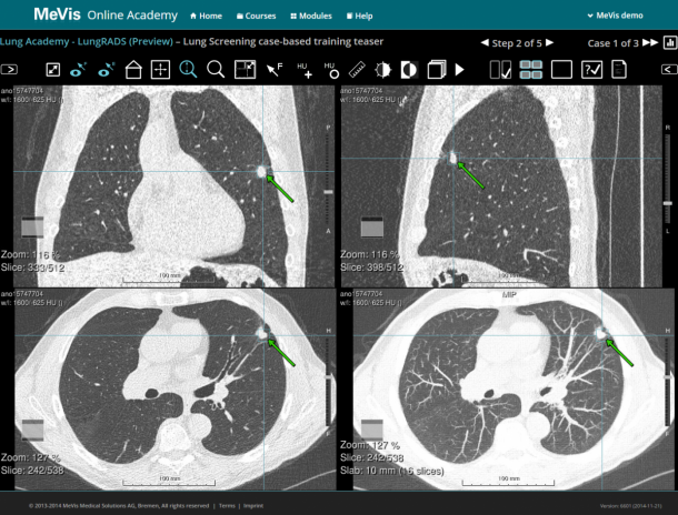 Training of interpretation and management of lung cancer screening images in...