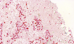 Tissue section of a human bladder tumour after immunotherapy simulation in a...