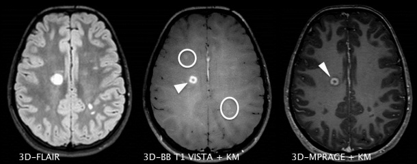 Schädel-MRT eines 15-jährigen Patienten mit bekannter Encephalitis...