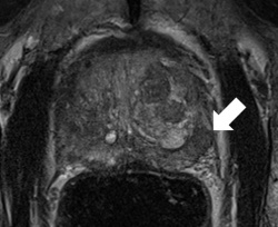 Fallbeispiel: Hochgradig tumorsuspektes Areal der Prostata in der peripheren...