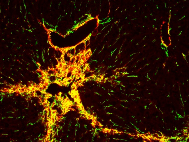 Liver fibrosis in a mouse: Labeling of two characteristic proteins (yellow)...