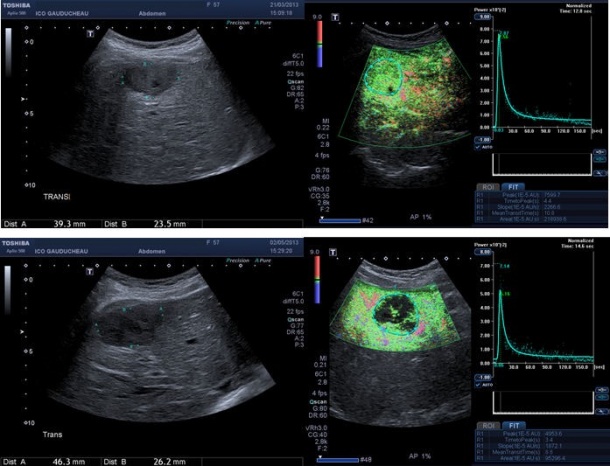 Hepatic metastasis before (upper images) and after 42 days of antiangiogenic...